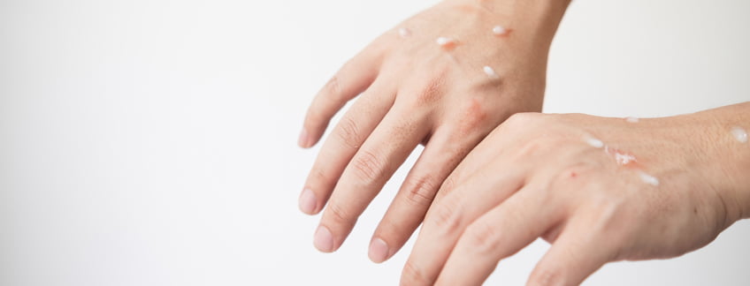 Acabar con la malaria matando a los mosquitos que pican a seres humanos: una prometedora herramienta para combatir esta enfermedad – EL PAÍS